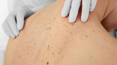 hudlege undersøker rygg for føflekker.