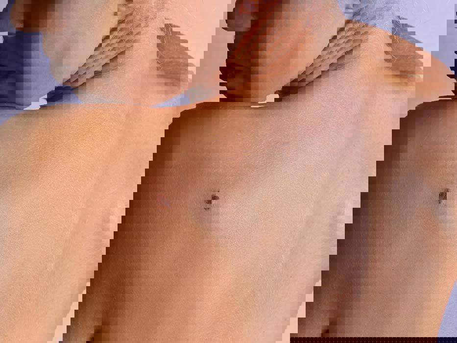 kvinne undersøker føflekk på ryggen.